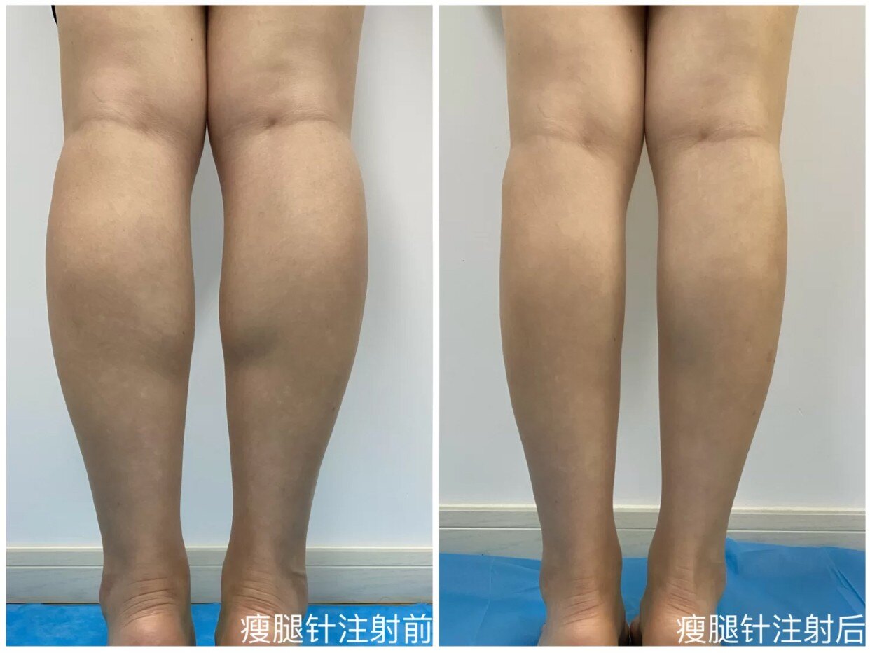 打botox瘦腿多少钱_打botox瘦腿_打botox瘦腿针好不好