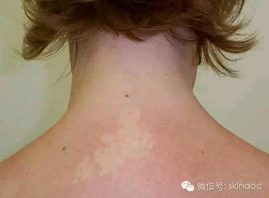 白癜风的症状_早期白癜风的症状_儿童早期白癜风症状